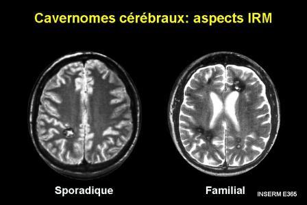 Cavernomes cerebraux